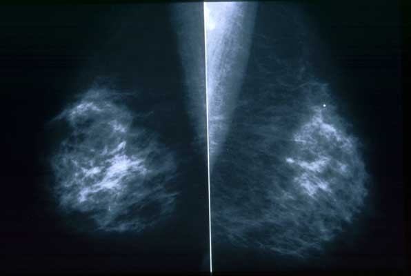 Images taken from breastcancer.org.  These are not my mammograms and to not highlight my particular cancer.  I tried to get mine online but might have to ask for them.