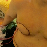 Right breast flap reconstruction. No nipple yet.