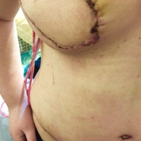 Closeup of right reconstructed breast.